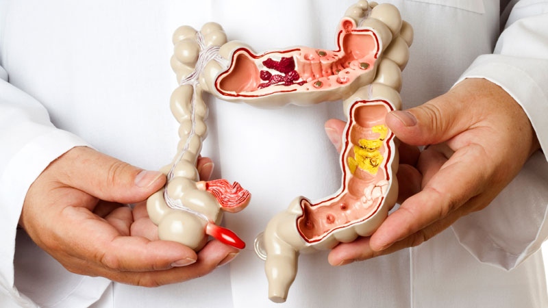 Ayurvedic approaches to irritable bowel syndrome and dyspepsia